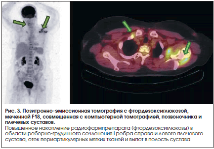 Фдг в онкологии при пэт кт