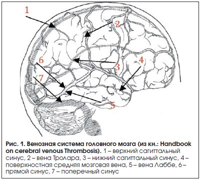 Тромбоз синусов мозга. Тромбоз венозного синуса головного мозга кт. Тромбозу синусов твердой мозговой оболочки головного мозга.