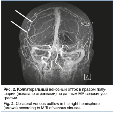 Рис. 2. Коллатеральный венозный отток в правом полу- шарии (показано стрелками) по данным МР-веносинусо- графии Fig. 2. Collateral venous outflow in the right hemisphere (arrows) according to MRI of venous sinuses