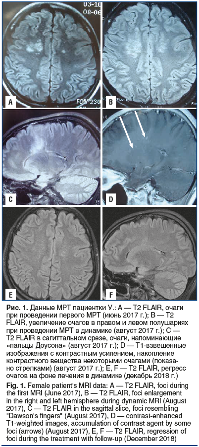 Рис. 1. Данные МРТ пациентки У.: А — T2 FLAIR, очаги при проведении первого МРТ (июнь 2017 г.); B — T2 FLAIR, увеличение очагов в правом и левом полушариях при проведении МРТ в динамике (август 2017 г.); C — T2 FLAIR в сагиттальном срезе, очаги, напоминаю