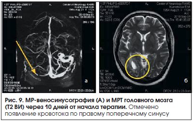 Асимметрия синусов головного мозга. Тромбоз поперечного синуса мрт. Тромбоз синусов головного мозга мрт. Тромбоз венозного синуса на мрт. Мрт поперечный синус головного мозга.